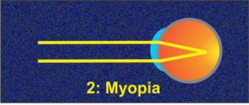 myopia