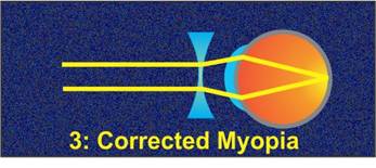 myopia kép fordul elő